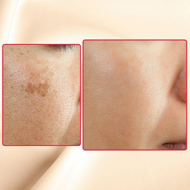 The Eraser Spot Cream | Dark Spot Remover