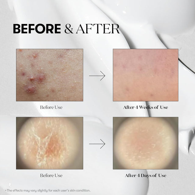 CICA Reedle Shot 100, Spicule Microneedling Serum for Pore Care & Exfoliation, Exosome, Centella Asiatica for Glass Skin, Skin Texture, Korean Liquid Skin Booster (1.69 Fl Oz / 50Ml)