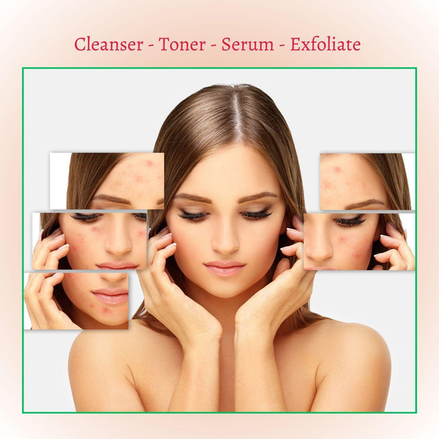 Perfect Trifecta Acne Peel