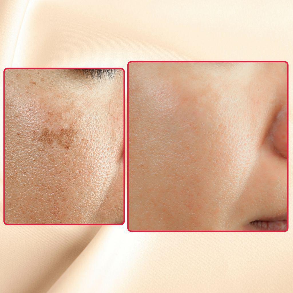 The Eraser Spot Cream | Dark Spot Remover